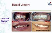 Case of the month – Dental Veneers