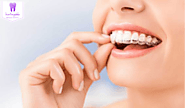 Invisalign Burwood Services And Its Numerous Benefits