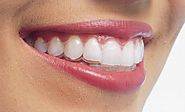 Why should you choose Invisalign Glen Waverley and its benefits?