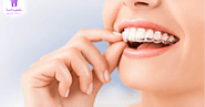 Invisalign Burwood Experts Offer The Easiest Way to Get Effective Treatment