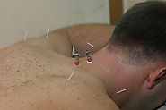 Find Best Acupuncture Therapists Online