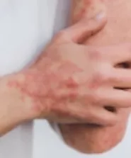 Ayurvedic treatment for psoriasis - All you need to know