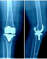 Knee Replacement in Mexico – Affordable, Reliable and Timely Alternative
