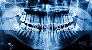 ARE DENTAL X-RAYS SAFE