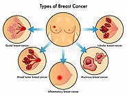 Types of Breast Cancer - Invasive & Non-Invasive