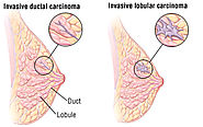Breast Cancer : Invasive Ductal Carcinoma (IDC)