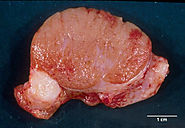 IDC Type: Mucinous Carcinoma of the Breast (Types of Breast Cancer)