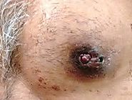IDC Type: Papillary Carcinoma of the Breast