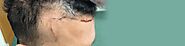 Looking For Scar-Free Hair Transplant? Consult The Best Hair Transplant Expert In Delhi