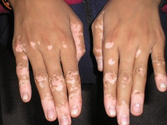 What are Vitiligo Causes and Symptoms?