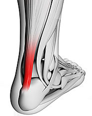 Achilles Tendinitis – Learn about the Treatment Methods
