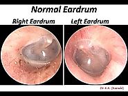 The Normal Eardrum - Otoendoscopy view