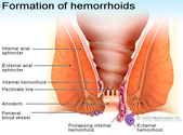 How To Cure External Hemorrhoids At Home