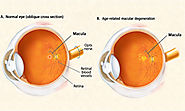 Eye Disorder Treatment at Affordable Price
