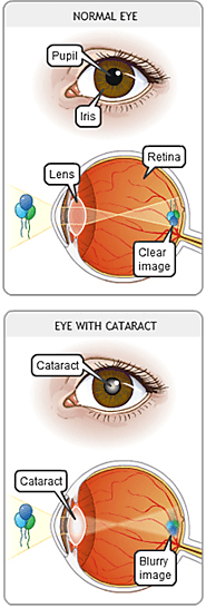 The Highest Standard of Cataract surgery: International Eye Surgery Center
