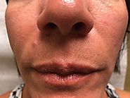 Lip Enhancement Treatment | Dermal Fillers NYC