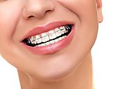 7 Myths about Orthodontic Methods and Treatment - Health Community Key