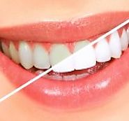Teeth Whitening Offers | Dentistree | Melbourne
