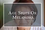 Age Spots Or Melanoma | Students Look