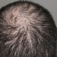 Does Vitiligo Cause Hair Loss | WNS LOGO DESIGNS