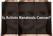 Is Actinic Keratosis Cancer? | Students Look