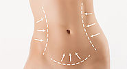 Have A Good Knowledge About Abdominoplasty