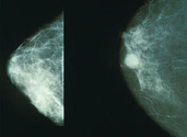 Breast cancer - Wikipedia, the free encyclopedia