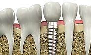 Find the Medical Facilitators for Dental Implants in Cancun