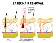 Common Myths about Laser Hair Removal in NY