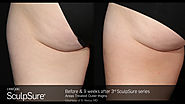 Painless Tummy Fat Burning Laser Treatment in NYC