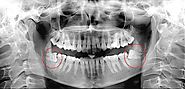 Impacted Wisdom Teeth - The Third molar