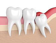 Do Wisdom Teeth Causes Crowding Of Other Teeth?