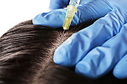 Non Surgical Hair Transplant - Fortes Medical