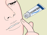 How to Get Rid of a Cold Sore Fast
