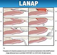 All About LANAP Procedure in Long Island – North Island Dental Arts – Medium