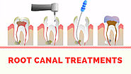 Root Canal Treatment New Hyde Park, Long Island: Everything You Should Know - NIDA