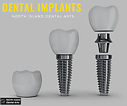 Procedure Of Getting Cosmetic Dental Implants in Long Island - Northislanddental