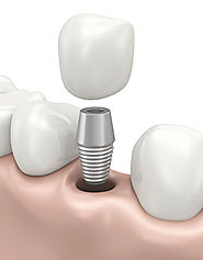 Keep Your Dental Implants Maintained and Clean - North Island Dental Arts