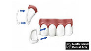 A Guide On Different Types Of  Dental Veneers – North Island Dental Arts