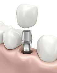 What Is Better: Dental Implants Or Dentures? - North Island Dental Arts