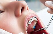 Should you choose Invisalign to straighten your teeth? – North Island Dental Arts- Long Island