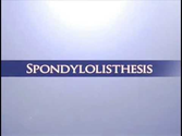 Spondylolisthesis Los Angeles | Spinal Vertebrae