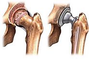 Hip Replacement: Normal Vs Minimally Invasive