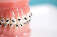 Orthodontics - Dentist in Cranbourne | Thompson Road Dental Services