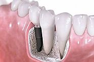 Implant Dentistry - Dentist in Cranbourne | Thompson Road Dental Services
