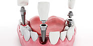 Implant dentistry | Teeth Implants Melbourne | Dental implants Melbourne