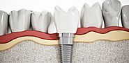 Best Teeth Implants Treatment in Melbourne | Prahran Family Dental
