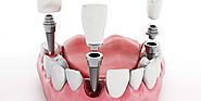 Complete guide about teeth implants Melbourne