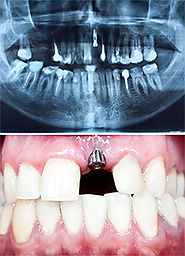 Get the best of the implant dentistry from Dental Implants Melbourne