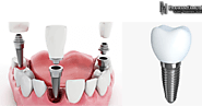 How teeth implants Melbourne services can help you to increase your confidence?